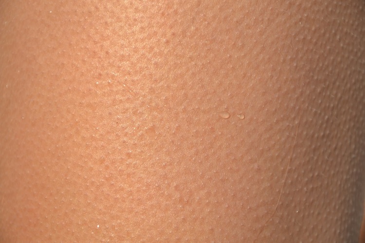 Goosebumps with water droplets on skin